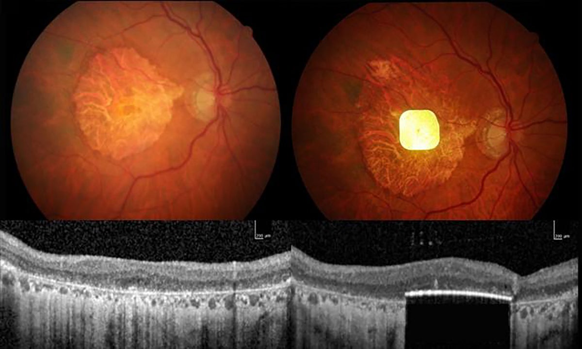 Innovative Retinal Implant Restores Reading Ability for Individuals with Blindness in Preliminary Trials – Mirror Brief